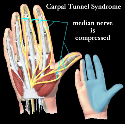 Carpal Tunnel Syndrome Carpal Tunnel Syndrome